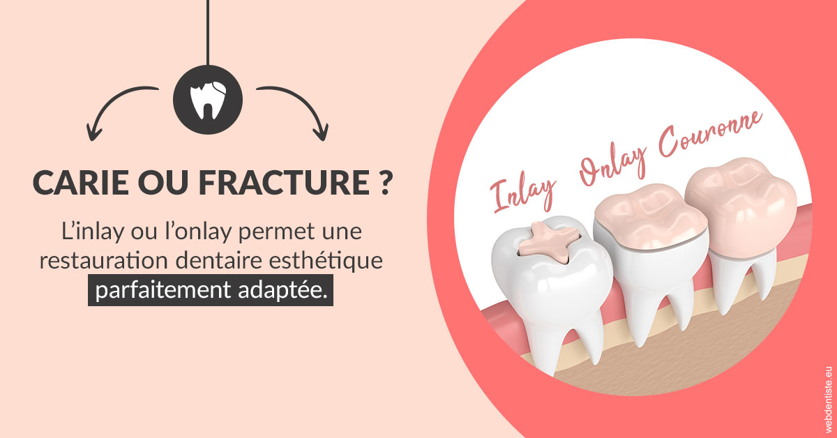 https://dr-lugon-emeric.chirurgiens-dentistes.fr/T2 2023 - Carie ou fracture 2
