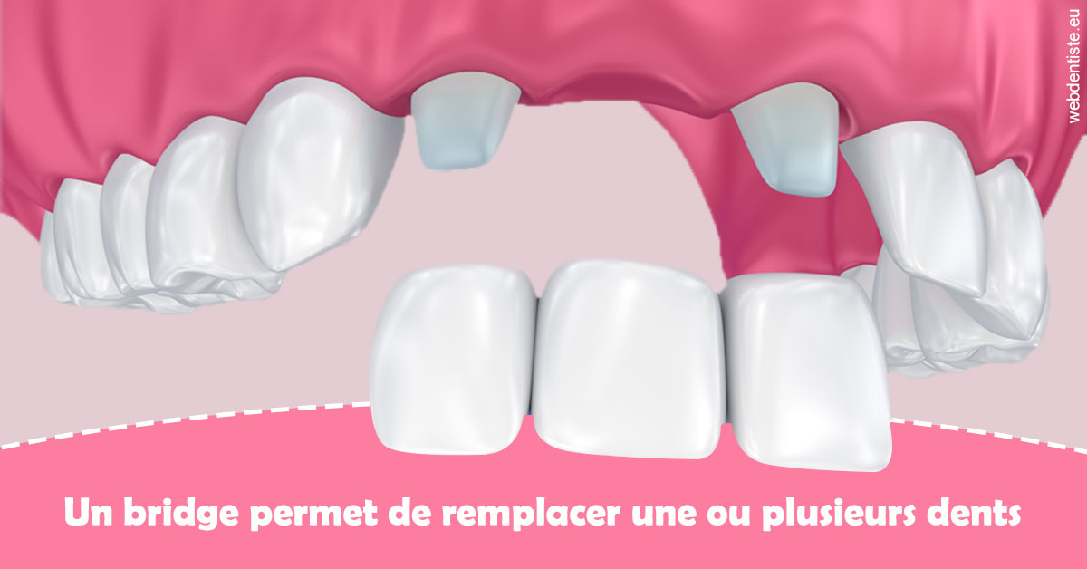 https://dr-lugon-emeric.chirurgiens-dentistes.fr/Bridge remplacer dents 2