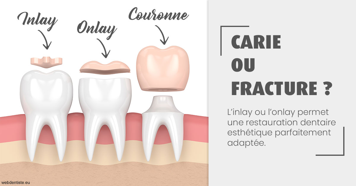 https://dr-lugon-emeric.chirurgiens-dentistes.fr/T2 2023 - Carie ou fracture 1