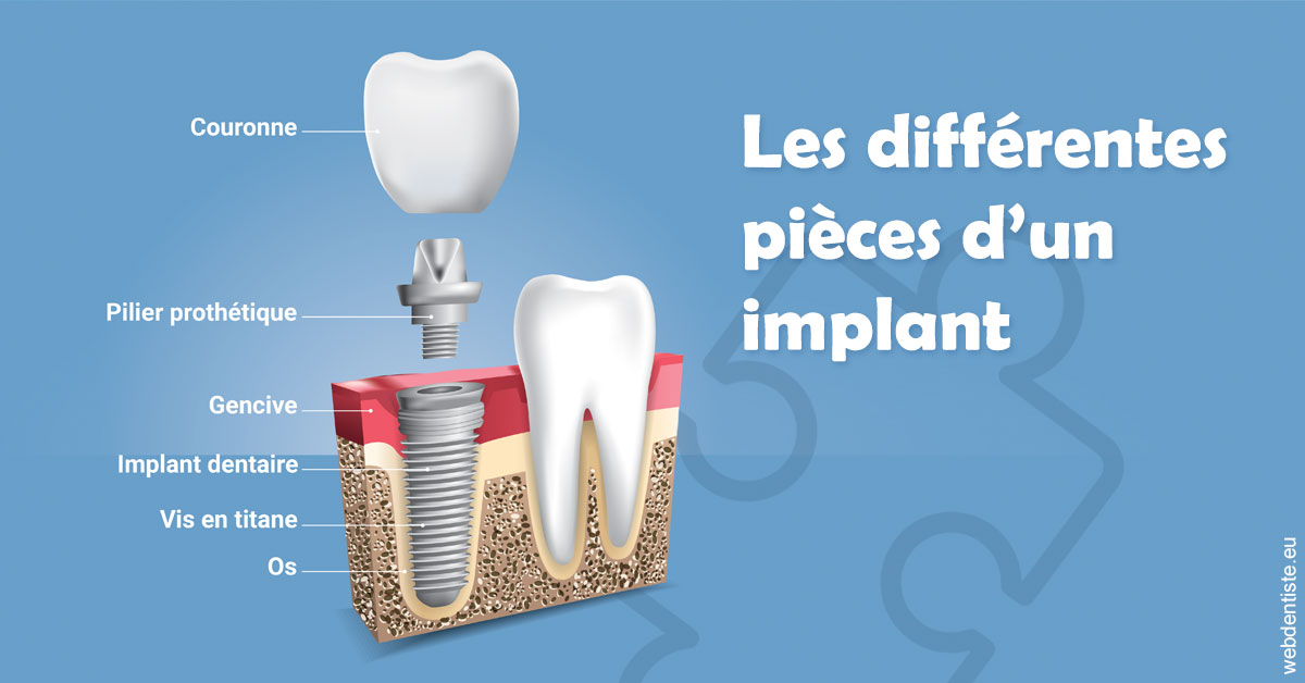 https://dr-lugon-emeric.chirurgiens-dentistes.fr/Les différentes pièces d’un implant 1